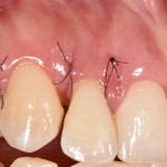 Puntos de sutura en periodoncia $USD